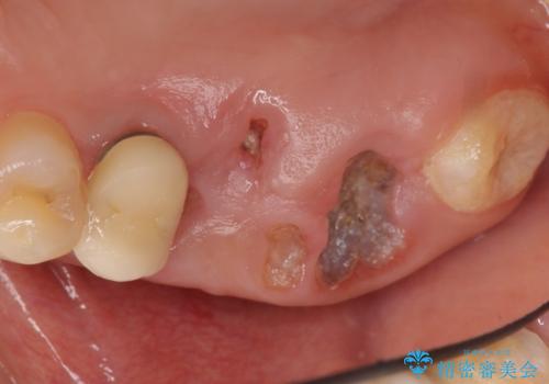 インプラントも入れ歯も嫌 親知らずの移植 20代女性の治療前