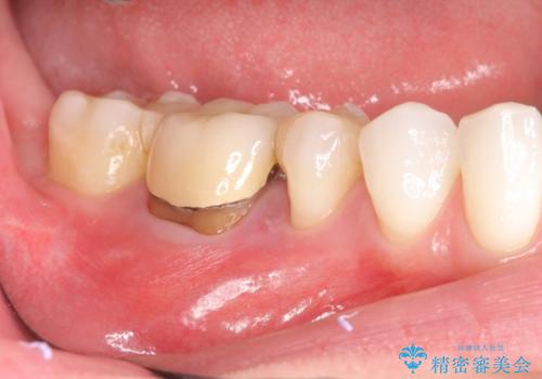 歯肉にできものがある、根管治療からセラミッククラウンまでの治療中
