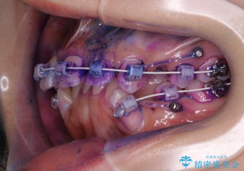 ワイヤー矯正中の歯のクリーニングの治療前
