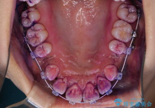 ワイヤー矯正中の歯のクリーニングの治療前