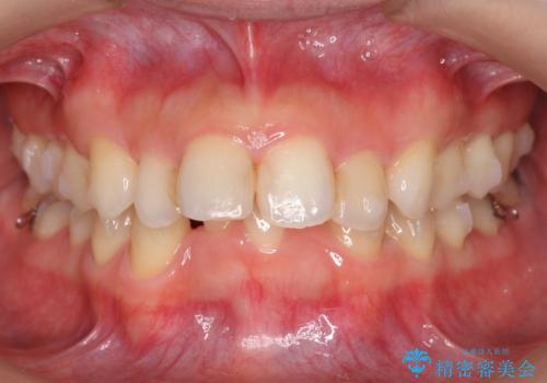 出っ歯 下の歯のガタガタ 下の前歯のみ1本抜歯 マウスピースで1年の治療中