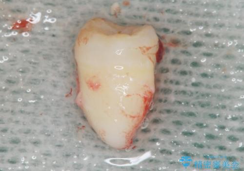 インプラントも入れ歯も嫌 親知らずの移植 20代女性の治療中