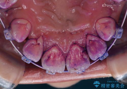 ワイヤー矯正中の歯のクリーニングの治療前