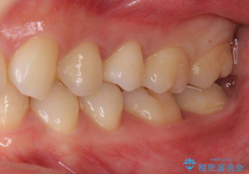 奥歯の虫歯　歯の間を広げてセラミックでしっかり治療の治療後