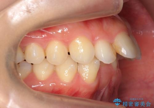 出っ歯　下の歯のガタガタ　下の前歯のみ1本抜歯　マウスピースで1年の治療中