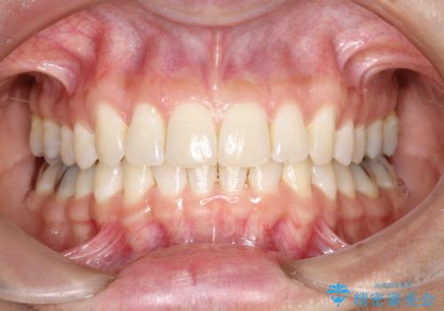前歯のガタガタをインビザラインで矯正の治療後