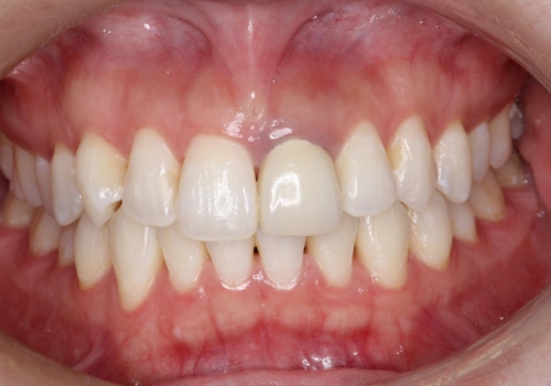 保険の被せ物をきれいにしたい オールセラミックの治療前