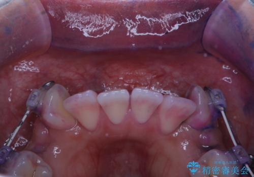 ワイヤー矯正中の歯のクリーニングの治療前