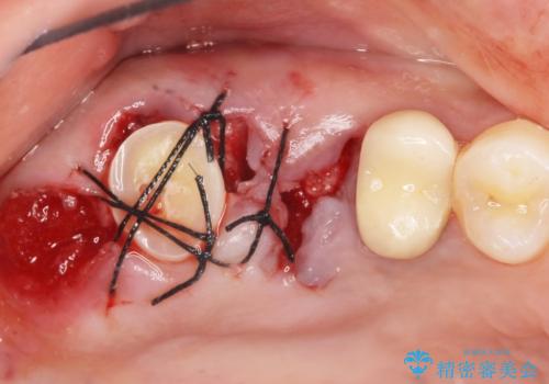 インプラントも入れ歯も嫌 親知らずの移植 20代女性の治療中