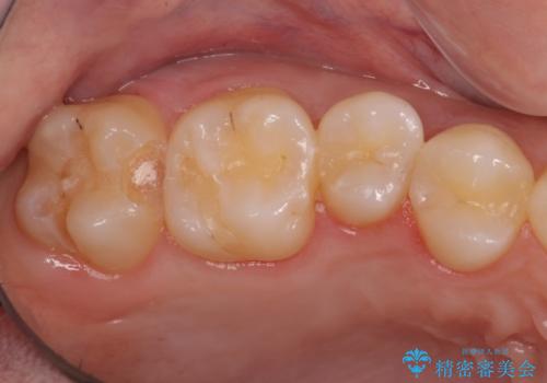 奥歯の虫歯　歯の間を広げてセラミックでしっかり治療の治療中