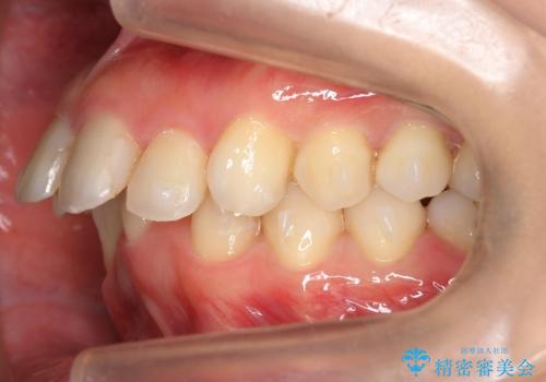 出っ歯 下の歯のガタガタ 下の前歯のみ1本抜歯 マウスピースで1年の治療中