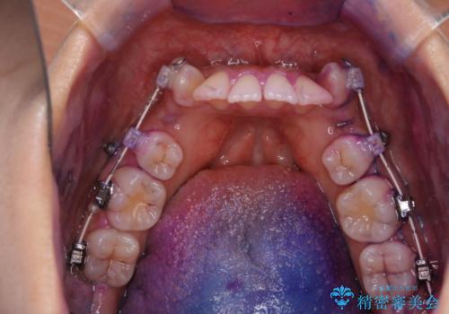 ワイヤー矯正中の歯のクリーニングの治療前