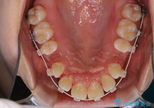 ワイヤー矯正中の歯のクリーニングの治療後
