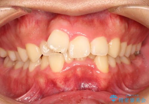 重度のガタガタ ワイヤーによる抜歯矯正の症例 治療前