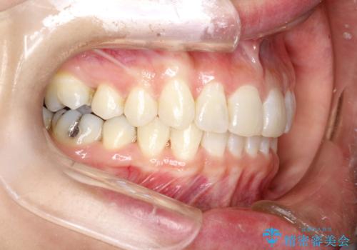 前歯のガタガタをインビザラインで矯正の治療後