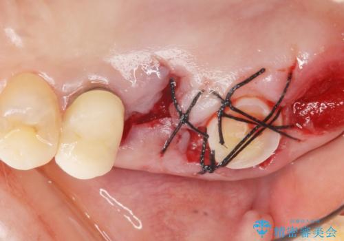 インプラントも入れ歯も嫌 親知らずの移植 20代女性の治療中