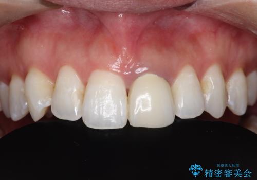 保険の被せ物をきれいにしたい オールセラミックの症例 治療前