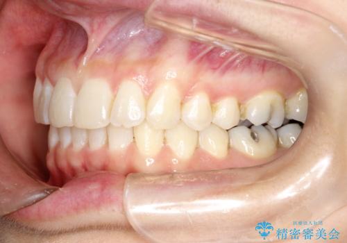 前歯のガタガタをインビザラインで矯正の治療後