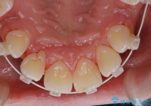 ワイヤー矯正中の歯のクリーニングの治療後