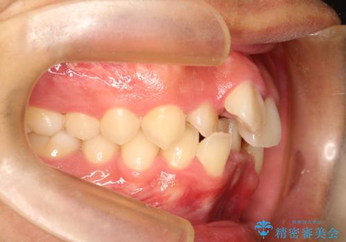 重度のガタガタ ワイヤーによる抜歯矯正の治療前