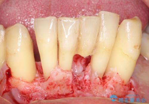 他院で抜歯と言われた歯 歯も神経も残したい 50代男性の治療中