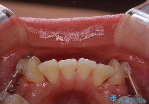ワイヤー矯正中の歯のクリーニングの治療後