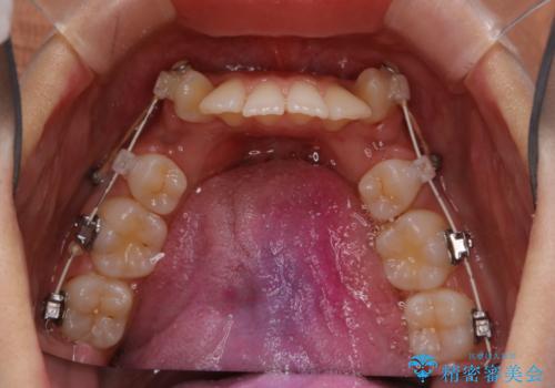 ワイヤー矯正中の歯のクリーニングの治療後