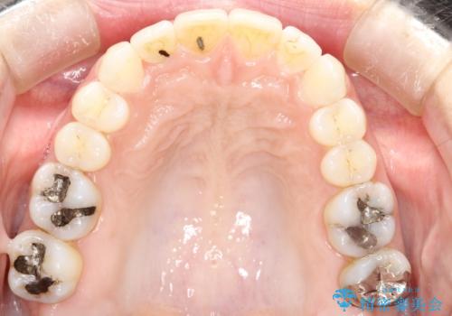 前歯のガタガタをインビザラインで矯正の治療後