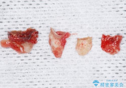 インプラントも入れ歯も嫌 親知らずの移植 20代女性の治療中