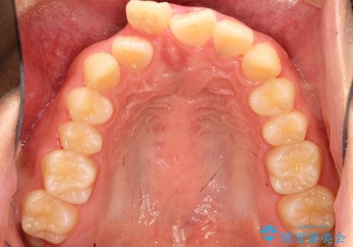 重度のガタガタ ワイヤーによる抜歯矯正の治療前