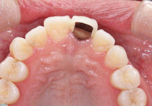 保険の被せ物をきれいにしたい オールセラミックの治療前