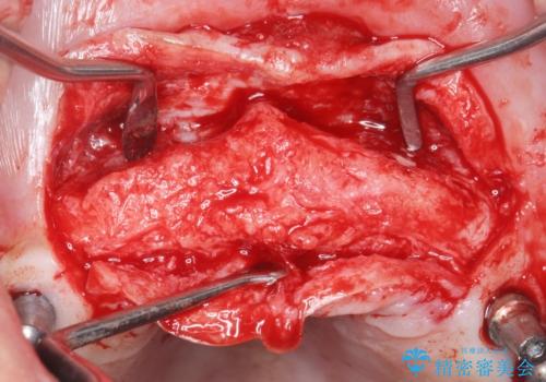 喫煙を再開してインプラント周囲炎に リカバリー治療 50代男性の治療中