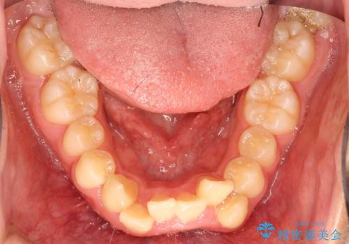重度のガタガタ ワイヤーによる抜歯矯正の治療前