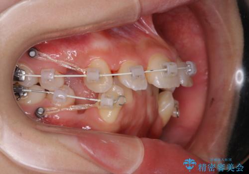 ワイヤー矯正中の歯のクリーニングの治療後