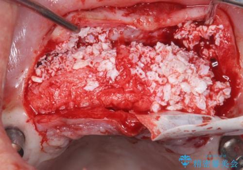 喫煙を再開してインプラント周囲炎に リカバリー治療 50代男性の治療中