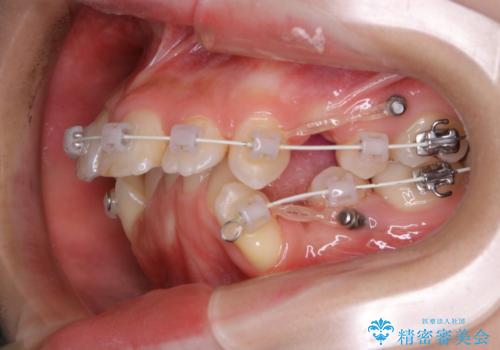 ワイヤー矯正中の歯のクリーニングの治療後