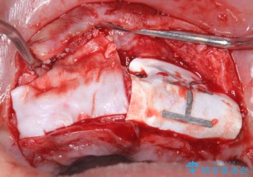 喫煙を再開してインプラント周囲炎に リカバリー治療 50代男性の治療中