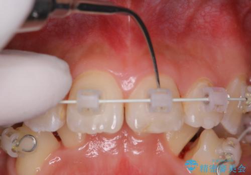 ワイヤー矯正中の歯のクリーニングの治療中