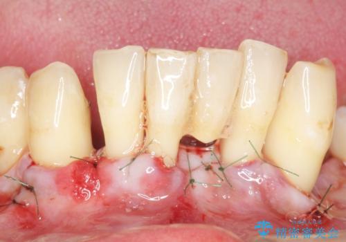 他院で抜歯と言われた歯 歯も神経も残したい 50代男性の治療中