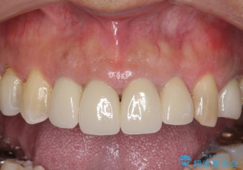 老朽化した前歯のクラウンやりかえの治療後
