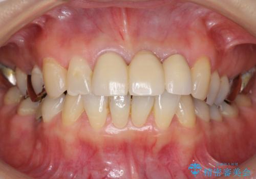 不自然なブリッジ 自然なセラミックでやりかえ 30代女性の治療前
