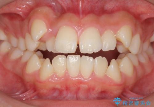 インビザラインチェンジで成功　インビザラインで八重歯の抜歯矯正の症例 治療前