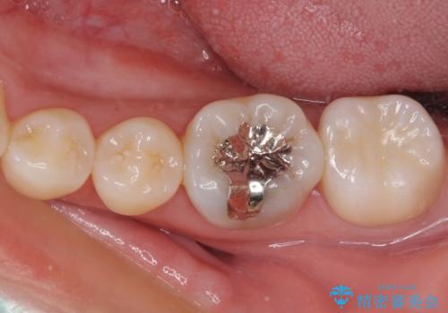 奥歯が痛い　保険治療後に症状が発現した歯のむし歯治療