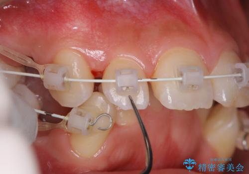 ワイヤー矯正中の歯のクリーニング