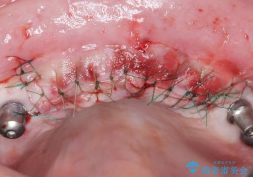 喫煙を再開してインプラント周囲炎に リカバリー治療 50代男性の治療中