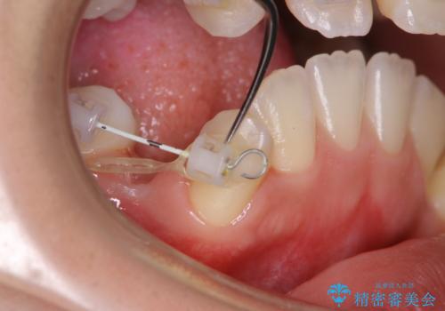 ワイヤー矯正中の歯のクリーニングの治療中