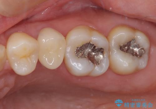 奥歯が痛い 保険治療後に症状が発現した歯のむし歯治療の治療後
