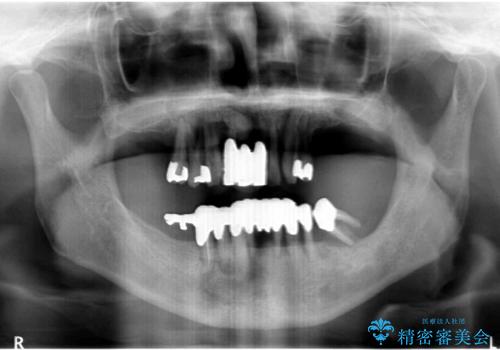 [ 重度歯周病 ] インプラント・義歯による咬合再構築の治療前