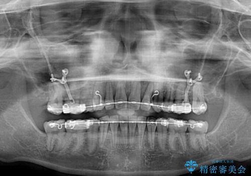 治療途中で転院 抜歯矯正の仕上げ治療の治療前