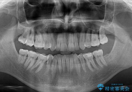 抜歯矯正の後戻りが気になる インビザライン・ライトによる矯正治療の治療前
